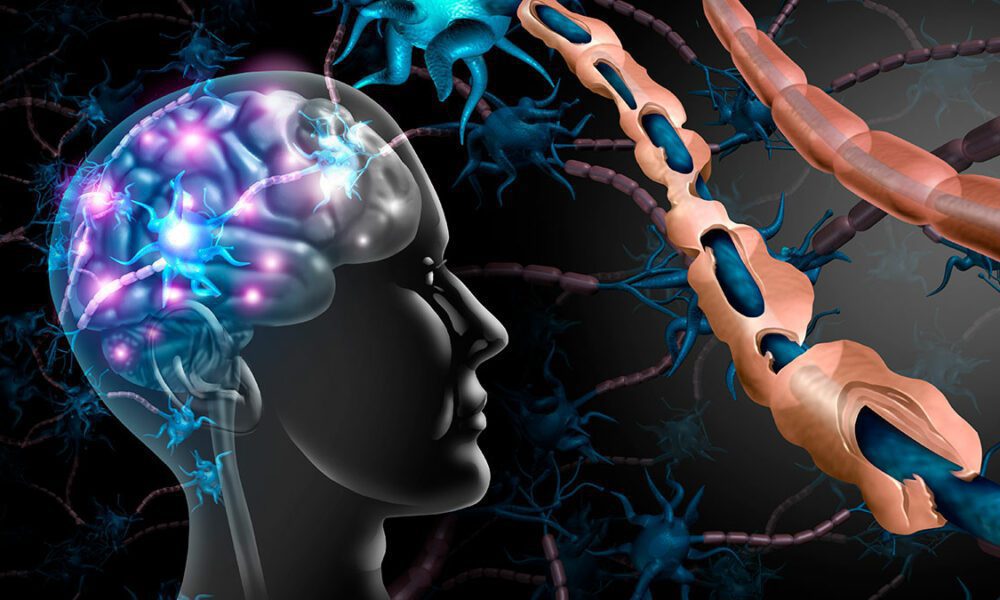 Cada-cinco-minutos-una-nueva-persona-es-diagnosticada-de-esclerosis-multiple-en-el-mundo-1000x600