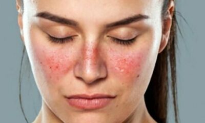 Lupus: cómo influye ante el COVID-19 y la exposición al sol.