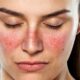 Lupus: cómo influye ante el COVID-19 y la exposición al sol.