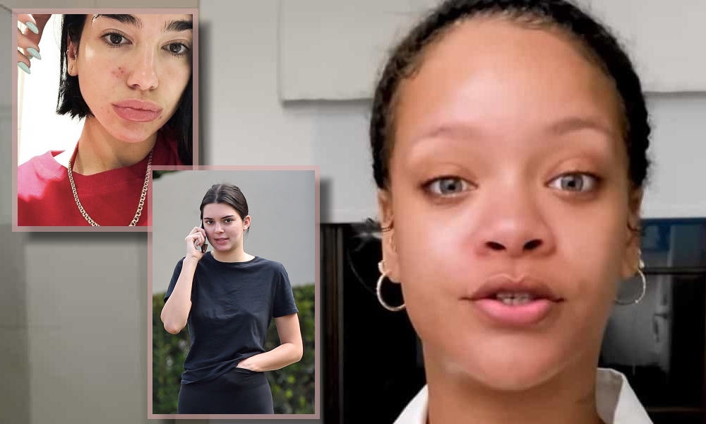 Rihanna, Dua Lipa, Kendall Jenner: son algunas de las famosas que se sumaron al «Skin Positive» mostrando su piel con acné y manchas. Rihanna, Dua Lipa, Kendall Jenner: son algunas de las famosas que se sumaron al «Skin Positive» mostrando su piel con acné y manchas.