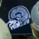 Científicos desarrollan un implante cerebral para eliminar pensamientos negativos y prevenir la depresión.