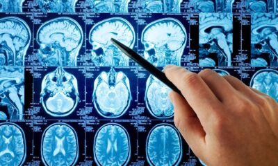 ¿Qué es un aneurisma cerebral?