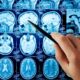 ¿Qué es un aneurisma cerebral?