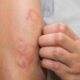 Alertan sobre una menor detección de la lepra debido a la pandemia.