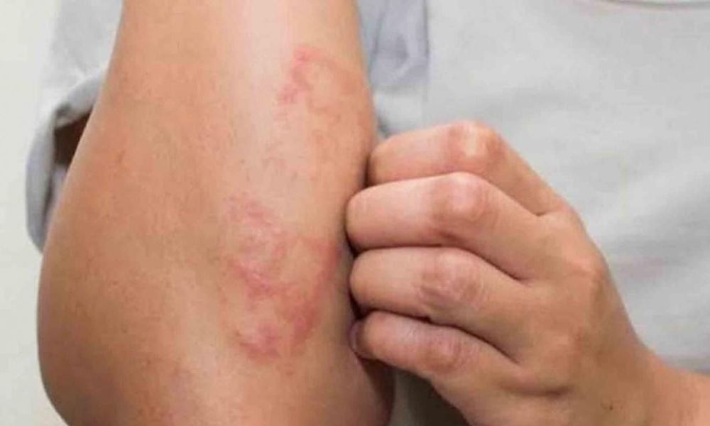 Alertan sobre una menor detección de la lepra debido a la pandemia. Alertan sobre una menor detección de la lepra debido a la pandemia.