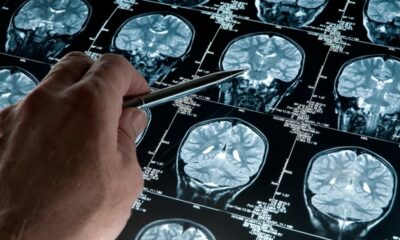 Desarrollan un software que podría diagnosticar de forma precoz el Alzheimer.
