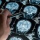 Desarrollan un software que podría diagnosticar de forma precoz el Alzheimer.