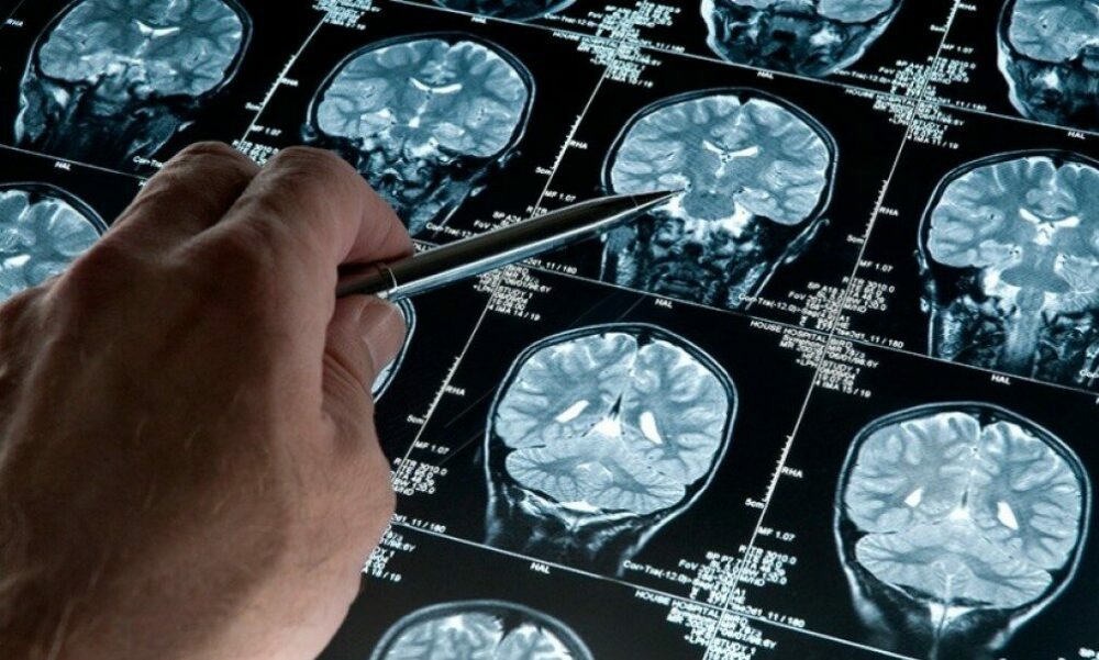 Desarrollan un software que podría diagnosticar de forma precoz el Alzheimer. Desarrollan un software que podría diagnosticar de forma precoz el Alzheimer.