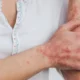 La OMS activó su máximo nivel de alerta sanitaria por la viruela del mono.