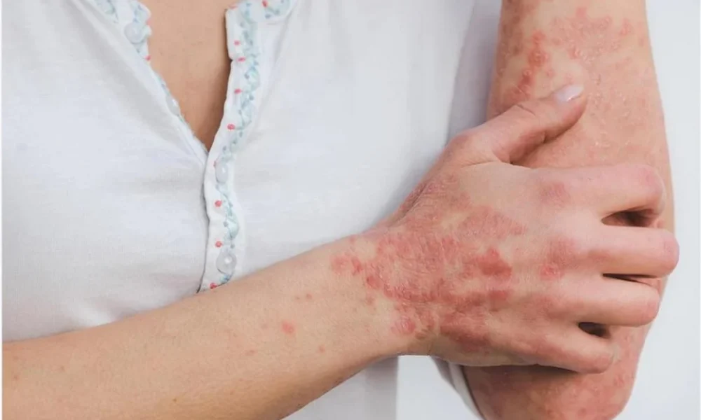 La OMS activó su máximo nivel de alerta sanitaria por la viruela del mono. La OMS activó su máximo nivel de alerta sanitaria por la viruela del mono.
