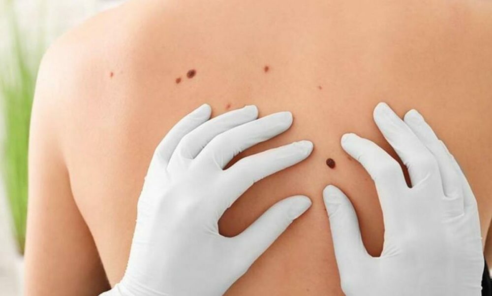 El Hospital Marcial Quiroga se suma a la campaña nacional de cáncer de piel. El Hospital Marcial Quiroga se suma a la campaña nacional de cáncer de piel.