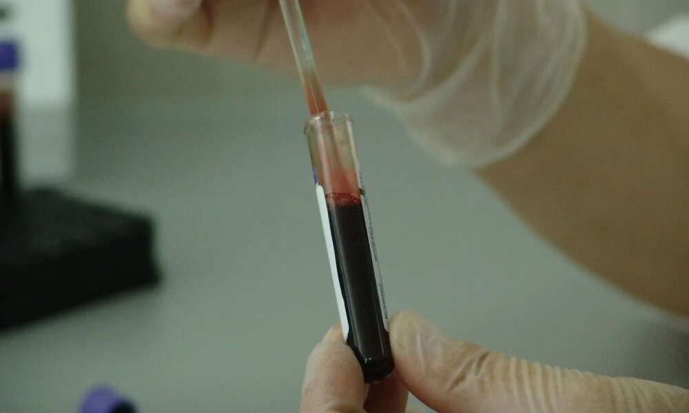Registran un caso de remisión del VIH tras un trasplante de médula. Registran un caso de remisión del VIH tras un trasplante de médula.