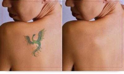 Tranqui, podés arrepentirte de ese tatuaje y removerlo de esta manera.