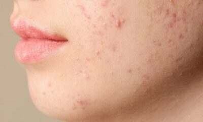 Cuidá tu piel, prevení el acné con estos tips.