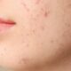 Cuidá tu piel, prevení el acné con estos tips.