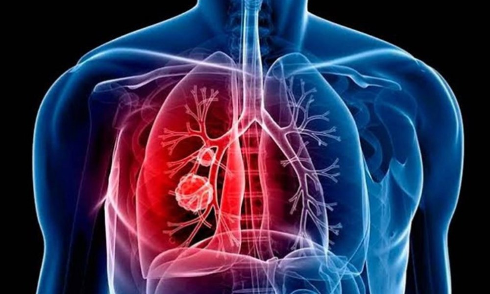 La importancia de las vacunas para prevenir la neumonía. La importancia de las vacunas para prevenir la neumonía.