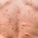 Viruela del mono en Argentina: suben a 8 los casos, pero no son de la variante más contagiosa.