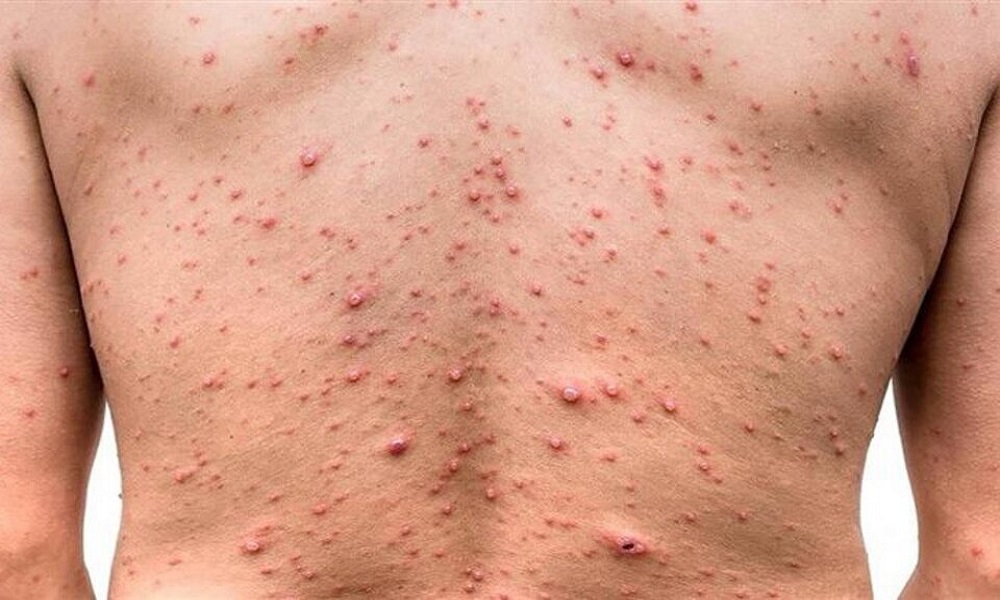 Viruela del mono en Argentina: suben a 8 los casos, pero no son de la variante más contagiosa. Viruela del mono en Argentina: suben a 8 los casos, pero no son de la variante más contagiosa.