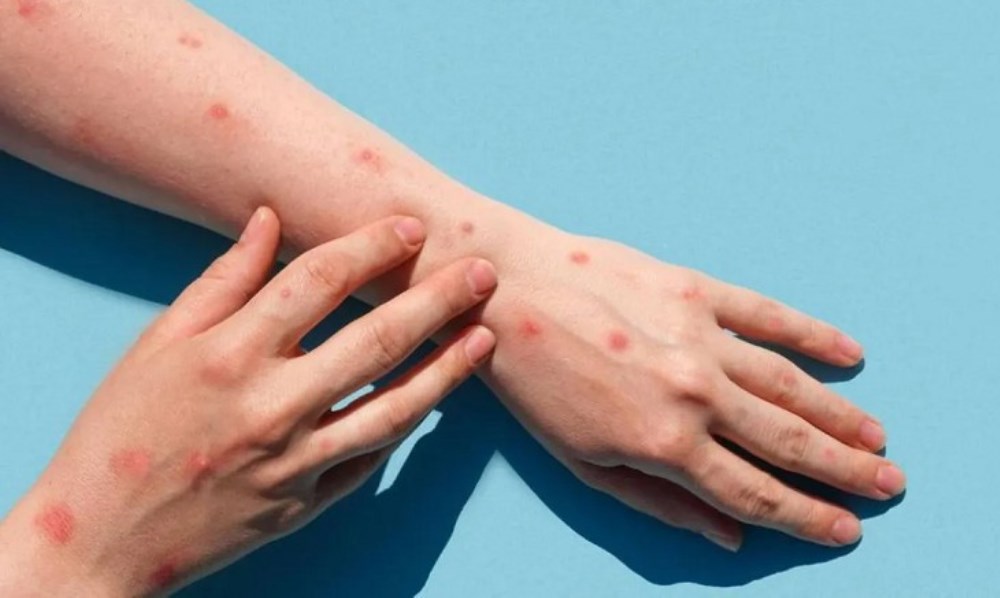 Viruela símica: cómo se transmite y como prevenir la enfermedad. Viruela símica: cómo se transmite y como prevenir la enfermedad.