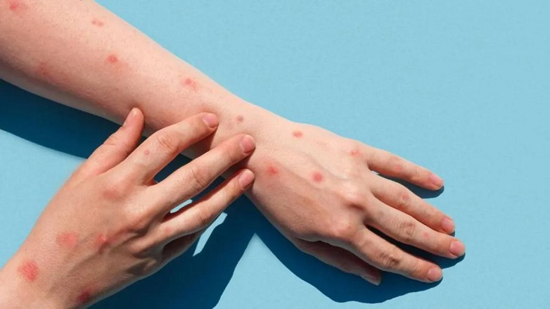 Viruela símica: cómo se transmite y cómo prevenir la enfermedad Viruela símica: cómo se transmite y cómo prevenir la enfermedad