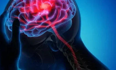Crece el ataque cerebrovascular, especialmente en adultos jóvenes