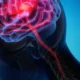 Crece el ataque cerebrovascular, especialmente en adultos jóvenes