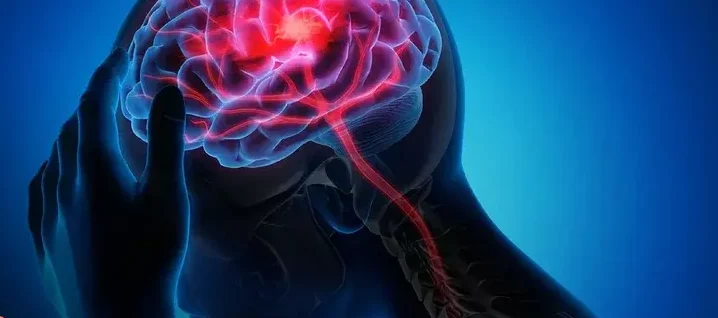 Crece el ataque cerebrovascular, especialmente en adultos jóvenes Crece el ataque cerebrovascular, especialmente en adultos jóvenes